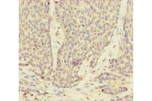 Immunohistochemistry of paraffin-embedded human ovarian cancer using ABIN7175186 at dilution of 1:100 (UACA Antikörper  (AA 1-90))