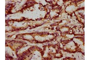 IHC image of ABIN7152685 diluted at 1:293 and staining in paraffin-embedded human colon cancer performed on a Leica BondTM system. (FRMD6 Antikörper  (AA 413-622))