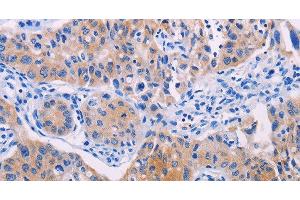 Immunohistochemistry of paraffin-embedded Human lung cancer using AGT Polyclonal Antibody at dilution of 1:30 (AGT Antikörper)