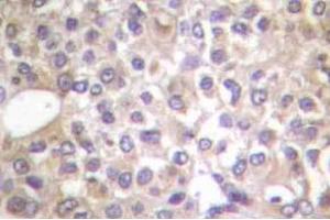 Immunohistochemistry (IHC) analyzes of p-PI3K p85 (pTyr458)/p55 (pTyr199) antibody in paraffin-embedded human breast carcinoma tissue. (PIK3R1 Antikörper  (pTyr199, pTyr458))