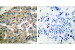Peptide - +Immunohistochemical analysis of paraffin-embedded human breast carcinoma tissue using FHIT antibody (#C0193). (FHIT Antikörper)