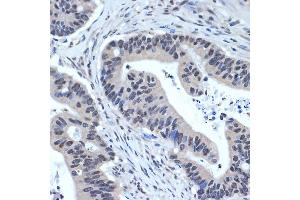 Immunohistochemistry of paraffin-embedded human colon carcinoma using XPD/ERCC2 Rabbit mAb (ABIN7267057) at dilution of 1:100 (40x lens). (ERCC2 Antikörper)