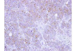 IHC-P Image Immunohistochemical analysis of paraffin-embedded SW480 xenograft, using ST3GAL2, antibody at 1:100 dilution. (ST3GAL2 Antikörper)