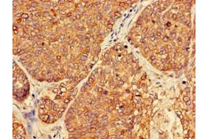 Immunohistochemistry of paraffin-embedded human ovarian cancer using ABIN7162911 at dilution of 1:100 (PER3 Antikörper  (AA 1-131))