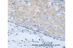 Immunohistochemistry of Human cervical cancer using CHRFAM7A Polyclonal Antibody at dilution of 1:40 (CHRNA7 Antikörper)