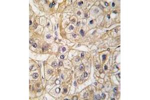 Formalin-fixed and paraffin-embedded human hepatocarcinoma tissue reacted with EGFR Antibody, which was peroxidase-conjugated to the secondary antibody, followed by DAB staining.