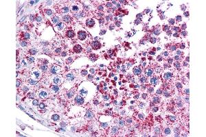 MAGEA3 antibody was used for immunohistochemistry at a concentration of 4-8 ug/ml. (MAGEA3 Antikörper  (Middle Region))