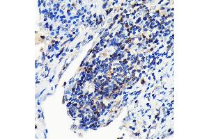Immunohistochemistry of paraffin-embedded human lung cancer using GRB2 Rabbit mAb (ABIN7267518) at dilution of 1:100 (40x lens). (GRB2 Antikörper)