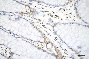 Immunohistochemistry was performed on paraffin-embedded human sigmoid colon carcinoma using histone H3 (di methyl K9) antibody (ABIN7798957), 1:200).