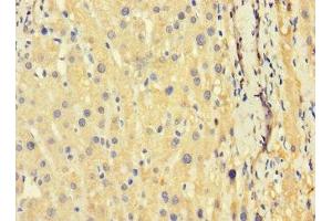 Immunohistochemistry of paraffin-embedded human liver cancer using ABIN7173626 at dilution of 1:100 (TSC22D3 Antikörper  (AA 58-134))