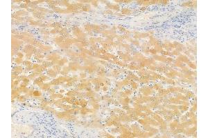 ABIN6258988 and ABIN6276084 at 1/100 staining human hepatocellular carcinoma by IHC-P.