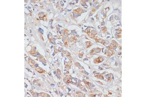 Immunohistochemistry of paraffin-embedded human breast cancer using DLL1 antibody (ABIN7266726) at dilution of 1:100 (40x lens). (DLL1 Antikörper  (AA 573-723))