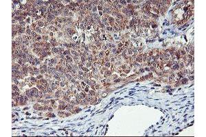 Immunohistochemical staining of paraffin-embedded Adenocarcinoma of Human ovary tissue using anti-AGPAT5 mouse monoclonal antibody. (AGPAT5 Antikörper)