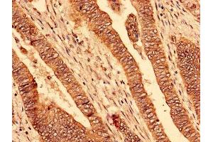 Immunohistochemistry analysis of human colon cancer using ABIN7163605 at dilution of 1:100 (PAFAH1B2 Antikörper  (AA 2-229))
