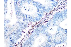 Immunohistochemistry of paraffin-embedded human colon carcinoma using Galectin 1/LG Rabbit mAb (ABIN7268197) at dilution of 1:100 (40x lens). (LGALS1/Galectin 1 Antikörper)