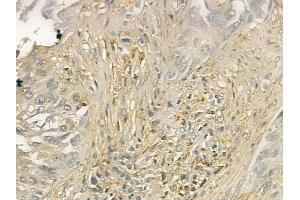 ABIN6260596 and ABIN6277004 at 1/100 staining human lung squamous cell carcinoma by IHC-P. (2B4 Antikörper  (N-Term))