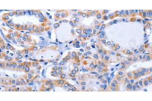 Immunohistochemistry of paraffin-embedded Human thyroid cancer using GFER Polyclonal Antibody at dilution of 1:50 (GFER Antikörper)