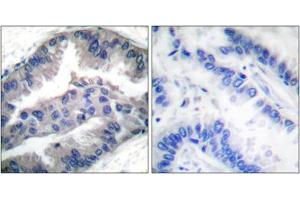 Immunohistochemical staining of paraffin-embedded human lung carcinoma tissue reacted with BIK (phospho T33) polyclonal antibody  at 1:50-1:100 dilution. (BIK Antikörper  (pThr33))