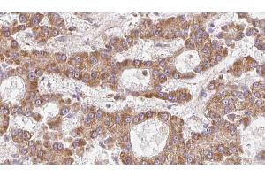 ABIN6273974 at 1/100 staining Human liver cancer tissue by IHC-P. (OR1L4/1L6 Antikörper)