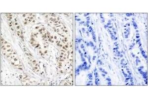 Immunohistochemistry analysis of paraffin-embedded human breast carcinoma, using BRCA1 (Phospho-Ser1524) Antibody. (BRCA1 Antikörper  (pSer1524))
