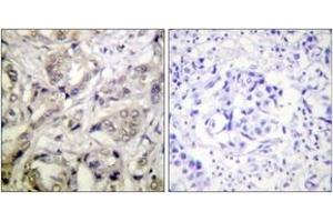 Immunohistochemistry analysis of paraffin-embedded human breast carcinoma tissue, using CaMK1-alpha (Ab-177) Antibody. (CAMK1 Antikörper  (AA 143-192))