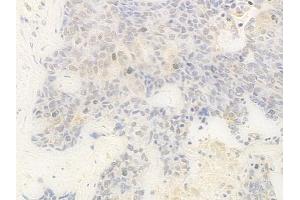 ABIN7095862 and ABIN7099924 at 1/100 staining human breast carcinoma by IHC-P.
