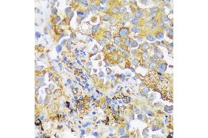 Immunohistochemistry of paraffin-embedded human lung cancer using ZDHHC18 antibody (ABIN7271549) at dilution of 1:100 (40x lens). (ZDHHC18 Antikörper  (AA 301-388))