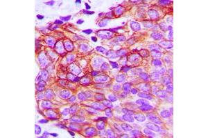Immunohistochemical analysis of Claudin 1 staining in human breast cancer formalin fixed paraffin embedded tissue section. (Claudin 1 Antikörper  (C-Term))