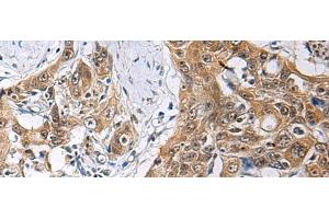 Immunohistochemistry of paraffin-embedded Human esophagus cancer tissue using THOC3 Polyclonal Antibody at dilution of 1:85(x200) (THO Complex 3 Antikörper)