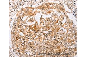 Immunohistochemistry of Human cervical cancer using PPP1CB Polyclonal Antibody at dilution of 1:30