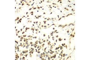 Immunohistochemistry of paraffin-embedded human liver cancer using HDAC2 antibody. (HDAC2 Antikörper  (C-Term))