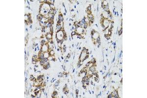 Immunohistochemistry of paraffin-embedded human colon carcinoma using SURF1 antibody (ABIN2560237) at dilution of 1:100 (40x lens). (SURF1 Antikörper)