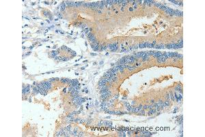 Immunohistochemistry of Human colon cancer using BAAT Polyclonal Antibody at dilution of 1:30 (BAAT Antikörper)