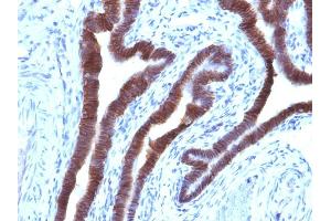 Formalin-fixed, paraffin-embedded human Ovarian Carcinoma stained with EpCAM Mouse Monoclonal Antibody (EGP40/1110).