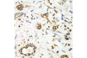 Immunohistochemistry of paraffin-embedded human liver cancer using NRBF2 antibody. (NRBF2 Antikörper  (AA 10-220))