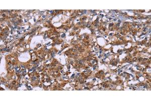 Immunohistochemistry of paraffin-embedded Human gastric cancer tissue using HSP10 Polyclonal Antibody at dilution 1:40 (HSPE1 Antikörper)