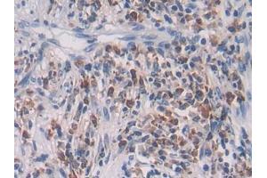 Detection of TGFb2 in Human Lung cancer Tissue using Polyclonal Antibody to Transforming Growth Factor Beta 2 (TGFb2) (TGFB2 Antikörper  (AA 303-414))