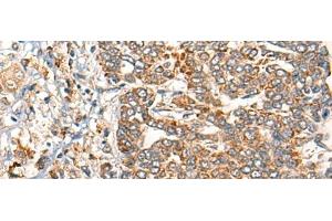 Immunohistochemistry of paraffin-embedded Human liver cancer tissue using EPHA6 Polyclonal Antibody at dilution of 1:40(x200) (EPH Receptor A6 Antikörper)