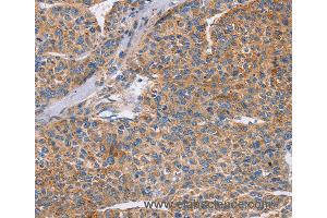 Immunohistochemistry of Human colon cancer using CDC7 Polyclonal Antibody at dilution of 1:70 (CDC7 Antikörper)