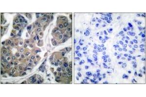 Immunohistochemistry analysis of paraffin-embedded human breast carcinoma, using eEF2 (Phospho-Thr56) Antibody. (EEF2 Antikörper  (pThr56))
