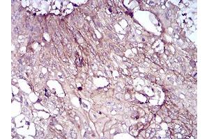 Immunohistochemical analysis of paraffin-embedded esophageal cancer tissues using CD6 mouse mAb with DAB staining. (CD6 Antikörper  (AA 18-199))
