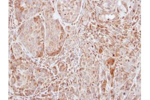 IHC-P Image Immunohistochemical analysis of paraffin-embedded A549 xenograft, using SOCS1, antibody at 1:100 dilution.