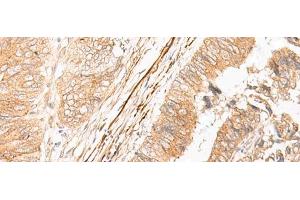 Immunohistochemistry of paraffin-embedded Human colorectal cancer tissue using EPS15 Polyclonal Antibody at dilution of 1:50(x200) (EPS15 Antikörper)
