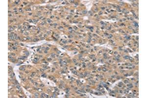 The image on the left is immunohistochemistry of paraffin-embedded Human liver cancer tissue using ABIN7192155(RBM38 Antibody) at dilution 1/35, on the right is treated with synthetic peptide. (RBM38 Antikörper)