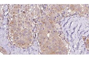 ABIN6273335 at 1/100 staining Human thyroid cancer tissue by IHC-P. (TRPC4AP Antikörper  (N-Term))