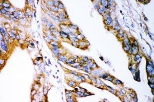 IHC-P: Claudin 2 antibody testing of human intestinal cancer tissue (Claudin 2 Antikörper  (AA 38-230))