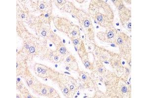 Immunohistochemistry of paraffin-embedded Human liver damage using PSMF1 Polyclonal Antibody at dilution of 1:100 (40x lens). (PSMF1 Antikörper)