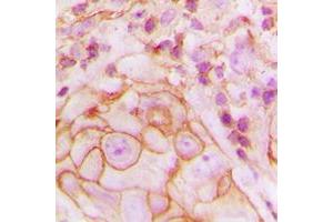 Immunohistochemical analysis of GPR105 staining in human breast cancer formalin fixed paraffin embedded tissue section. (P2RY14 Antikörper  (Center))