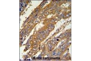 N3 Antibody (C-term) (ABIN651149 and ABIN2840100) IHC analysis in formalin fixed and raffin embedded human cervix carcinoma followed by peroxidase conjugation of the secondary antibody and DAB staining. (PAN3 Antikörper  (C-Term))