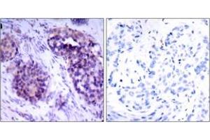 Immunohistochemistry analysis of paraffin-embedded human breast carcinoma tissue, using BCL-XL (Ab-62) Antibody.